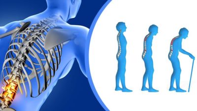 Tratament alternativ pentru osteoporoza